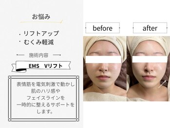 シロ(CHILO)/EMS Vリフトbefore・after
