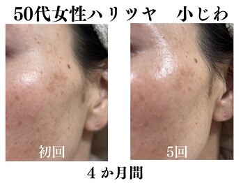 ランティル(l’until)の写真/40代50代シミ/くすみ/小じわをケアしてハリツヤを！理想の自分に出会う【ララピール】で素肌が輝く♪