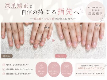 カフナ アンド チル(Kahuna&chill)の写真/深爪矯正で自然な美爪へ導く、船橋ネイルサロン！自爪育成×悩み解消ケアも◎爪状態に合わせた丁寧な施術