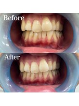 ベルカーラ(Belcarra)/BIHAKU セルフホワイトニング