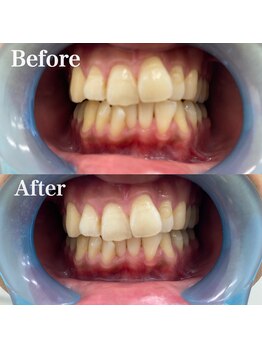 ベルカーラ(Belcarra)/BIHAKU セルフホワイトニング