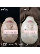 奏美/ハーブピーリング