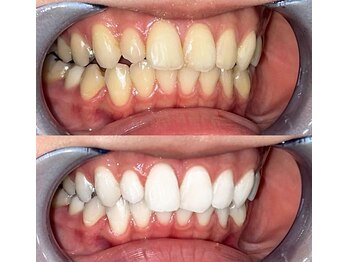 ラブホワイトニング 新宿店(LOVEホワイトニング)/驚き効果のホワイトニング