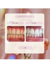 プラスビーセルフ(+b self)/ホワイトニングビフォーアフター