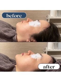 オーロラ(Aurora)/サブスク　フェイシャル　1回目