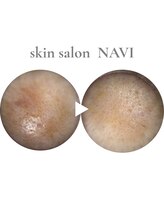 ナビ(NAVI)/シミくすみケア／美白肌管理