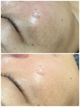 アスピリア(aspirer a')/石膏パックでお顔のデトックス◎