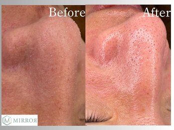 ミラー(MIRROR)/熊本市/毛穴洗浄/西熊本/くすみ