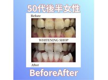 ホワイトニングショップ 西原店/50代後半女性☆BeforeAfter