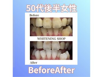 ホワイトニングショップ 西原店/50代後半女性☆BeforeAfter