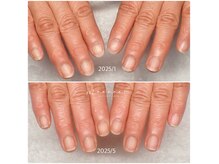 深爪 手荒れ 爪と手肌のお悩みにネイルケア/自爪ケア/爪育成