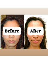 マンマ ジュンナ 小顔 矯正