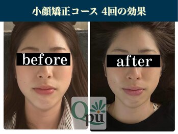 キュープ 表参道店(Qpu)/たった4回でここまで変わります