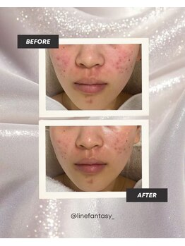 ラインファンタジー 武庫之荘店/ハーブピーリング