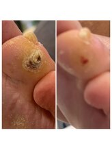 ニコ(niko)/辛い指先のタコを除去