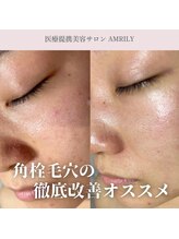 アムリリー 南草津店(AMRILY)/定期的な毛穴の大掃除