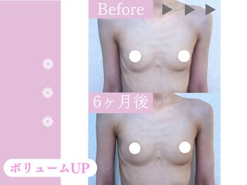 キアナ 横浜店(Kiana)/バストアップBefore After