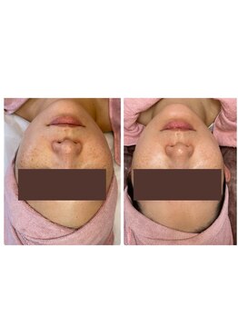 シフォン(Chiffon)/シミケアbefore after