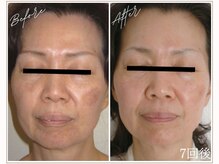 ミューベル(MYubelle)/エイジングケア　水光ピーリング