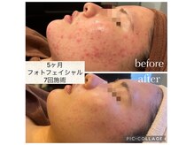 【即効果】フォト光フェイシャル7回施術でこの結果！！