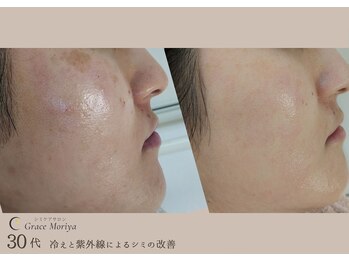 グレイス モリヤ(Grace Moriya)の写真/シミ改善しながら、水光ピールで美白ケア♪ふっくら肌を目指す極上のエステ体験を！