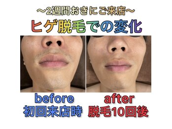 ホーミーズ 燕三条(HOMIES)/ヒゲ脱毛10回の変化