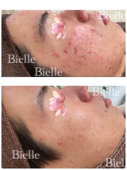 ビエル(Bielle)/もう諦めかけていたアクネケア、