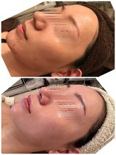 ヘアメイク エステサロン クラシカ(hairmake esthe salon clasika)/VOSサロンケア肌改善