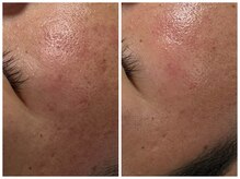 フェリス(FELIZ)/プラズマフェイシャル