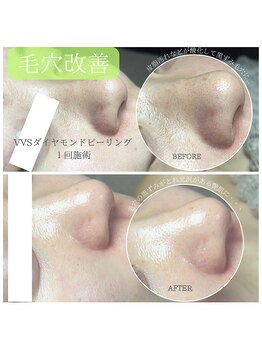 カルナ(CARNA)/VVSダイヤモンドピール施術前後