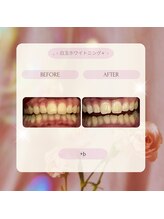 プラスビー 2号店(+b)/ホワイトニングビフォーアフター