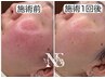【鎮静ケア】肌のバリア機能回復＆免疫UP★毛穴洗浄＋パック付き　¥12000 