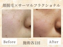 ミスティア(mistia)/脱毛×エステ【顔】各1回/2週間