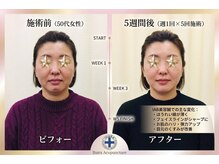 井原鍼灸整骨院/IAB美容鍼