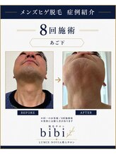 ビビ(bibi)/メンズヒゲ脱毛 施術8回