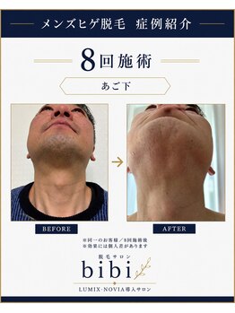 ビビ(bibi)/メンズヒゲ脱毛 施術8回