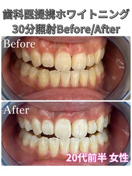 プラチナムビューティ 四条烏丸店(PLATINUM Beauty)/ホワイトニング!Before./After!