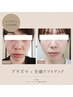 【ほうれい線・たるみに】老け見え印象を若々しく◇ハリ艶フェイシャル¥11000