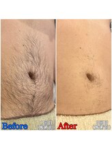 ファビー(Fabby)/メンズ脱毛★腹のビフォアフ