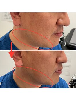 みつばちさろん/【ブラックスタンプ】顔