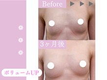 キアナ 横浜店(Kiana)/バストアップBefore After