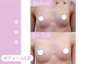 キアナ 横浜店(Kiana)/バストアップBefore After