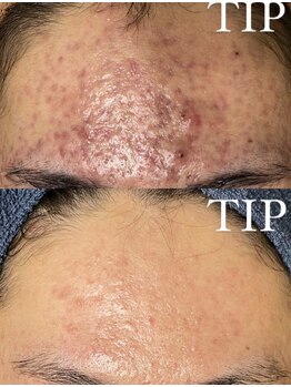 エル(Elle)/繰り返すニキビケア