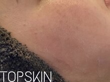トップスキン 表参道(TOPSKIN)/ハーブピーリング専門店☆表参道