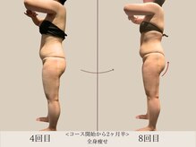 エル 麻布十番(LllL)/【痩身】2ヶ月半ビフォアフ