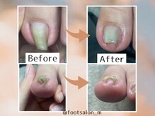 エム 平岸(M)/巻き爪ケア　1回目