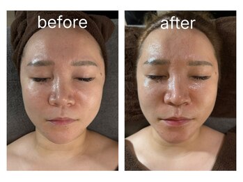 サロン ド プリリ(Salon de Puriri)/ハーブピーリング