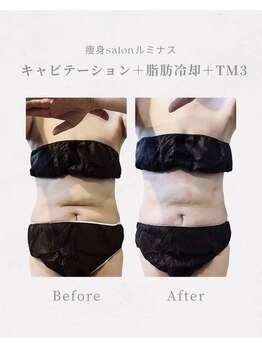 ルミナスの写真/脂肪を狙ってケアするだけでなく、TM3でしっかり引き締めることで、よりスッキリとしたボディラインへ