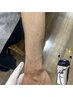うっかり剃り忘れの不安ゼロへ！　腕全体＋手指甲　光脱毛  ￥5,000
