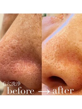 エヌ アンド エイチ ソニックフィット(N&H sonicfit)/鼻のケアコース